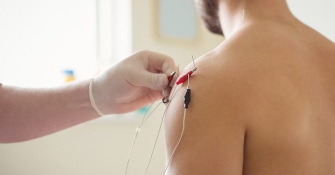 Dry Needling