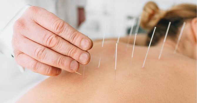 Acupuncture